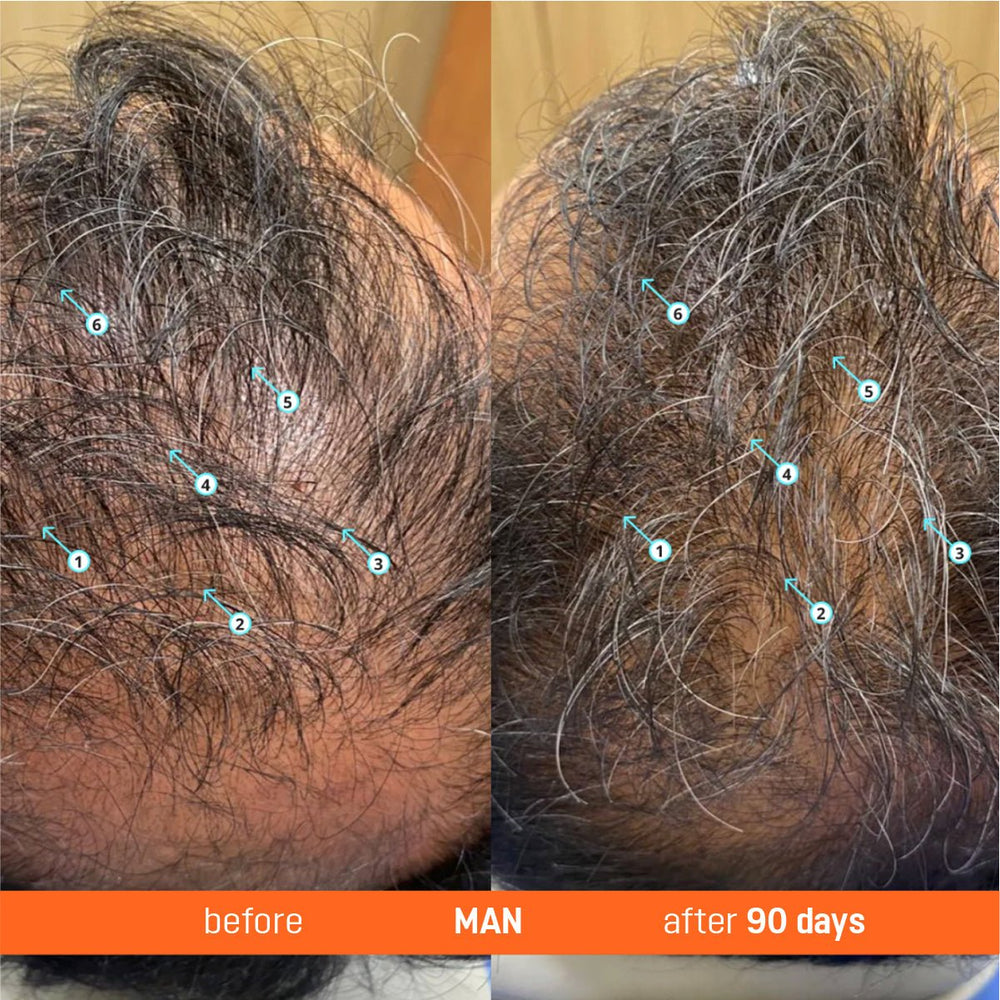 Abera Hair Serum with Redensyl — 3 Month Supply (3 Bottles) + Free Gold Scalp Roller