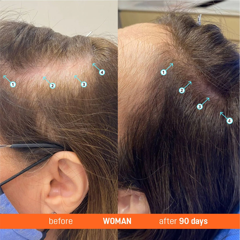 Abera Hair Serum with Redensyl — 3 Month Supply (3 Bottles) + Free Gold Scalp Roller